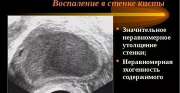 Лечение эндометриоза Визанной, киста яичника Лечение эндометриоза Визанной, киста яичника