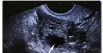 Узи показывет в ячники желтое тело есть ли беременность Узи показывет в ячники желтое тело есть ли беременность