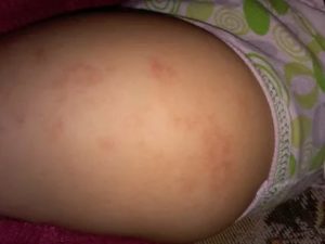 Сыпь на попе у ребенка