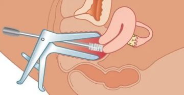 Может ли беременная отказаться от взятия мазков