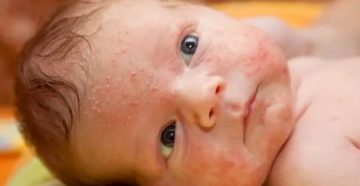 Аллергия у грудного ребенка, чешет лоб, лицо и грудь