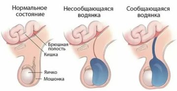 Сдавили одеждой яички ребенку