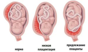 Может ли плацента опуститься