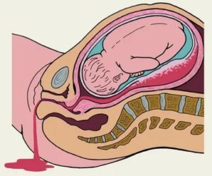 Отслойка плаценты перед родами
