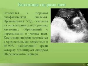 Кистозная гигрома шеи плода