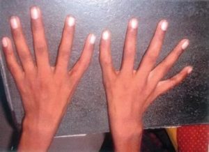 Удлинение фаланги большого пальца руки