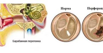 Обезболивание при перфорации перепонки уха