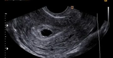 Анэмбриония на сроке 6 недель Анэмбриония на сроке 6 недель