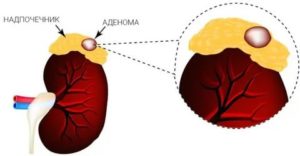 Аденома надпочечников