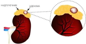 Аденома надпочечников