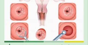 Беременность после конизации шейки матки