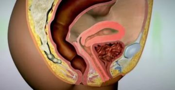 Острая боль внутри влагалища Острая боль внутри влагалища