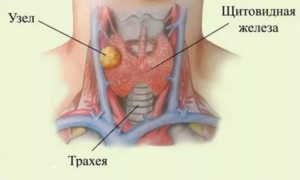 Узел в щитовидной железе