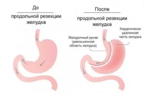 Температура после резекции желудка