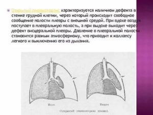 Пневмоторакс легкого, не выходит воздух