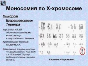 Моносомия хромосомы Х