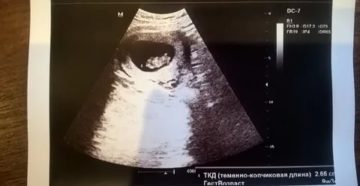 Беременность 10 недель, красные выделения Беременность 10 недель, красные выделения