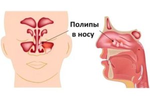 Аденоиды и заложенность носа