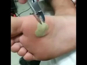 Свищ на пальце ноги после удаления сухой мозоли