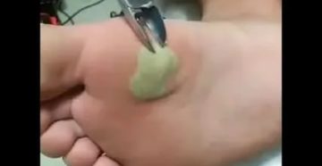 Свищ на пальце ноги после удаления сухой мозоли