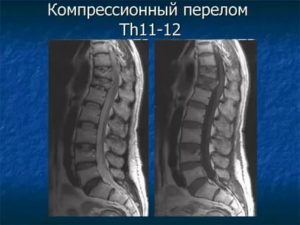 Компрессионный перелом TH12