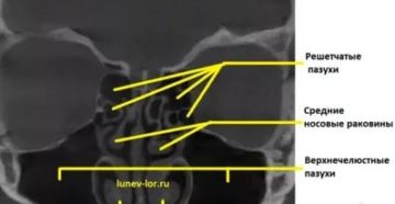 Пневматизация придаточных пазух носа