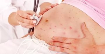 Беременность после ветрянки