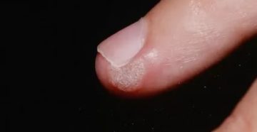 Сухой нарост на пальце руки около ногтя