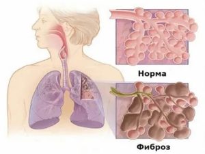 Фиброз после пневмонии норма ли?