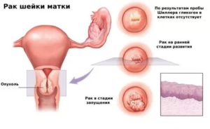 Кондиломы и воспаление шейки матки