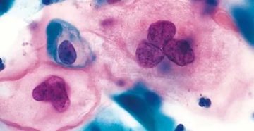 Цитологическое исследование. Паракератоз плоского эпителия Цитологическое исследование. Паракератоз плоского эпителия