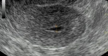 Скопление жидкости в цервикальном канале Скопление жидкости в цервикальном канале