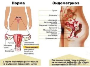 Боль при половом акте во время беременности