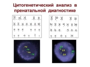 Расшифровка цитогенетического исследования