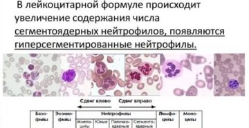 Увеличение общих лейкоцитов в крови без изменения лейкоцитарной формулы