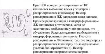 Нарушение процесса реполяризации в миокарде у подростка