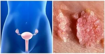 Вагинальная аллергия во влагалище Вагинальная аллергия во влагалище