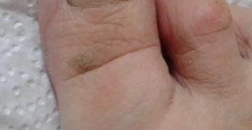 Темные пятна между пальцами