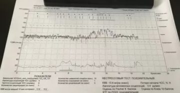 Расшифровка КТГ, оценка по Фишер 8, Кребс 10, нестрессовый тест положительный Расшифровка КТГ, оценка по Фишер 8, Кребс 10, нестрессовый тест положительный