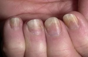 Кровоизлияния под ногтями и ногти отходят от ложа