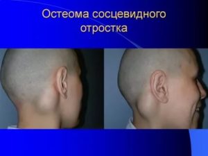 Образование левого сосцевидного отростка (остеома)