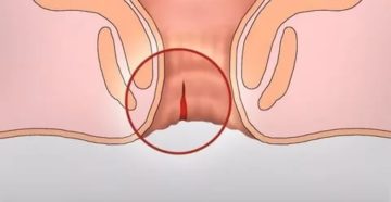 Трещине возле влагалища Трещине возле влагалища