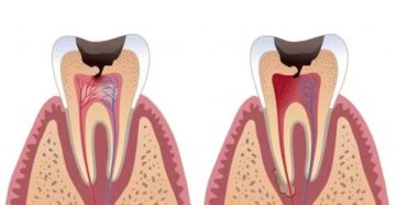 Может пульпит не проявляться и как диагностировать пульпит?
